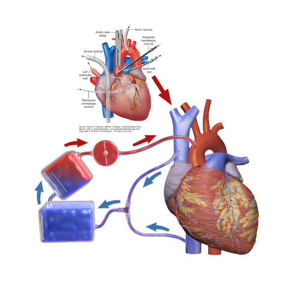 The basic idea behind arresting the heart is to halt its metabolism